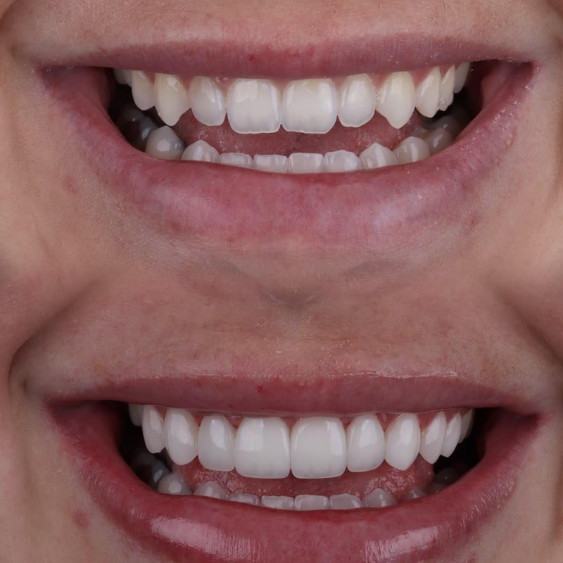 Antes e depois com modelagem natural