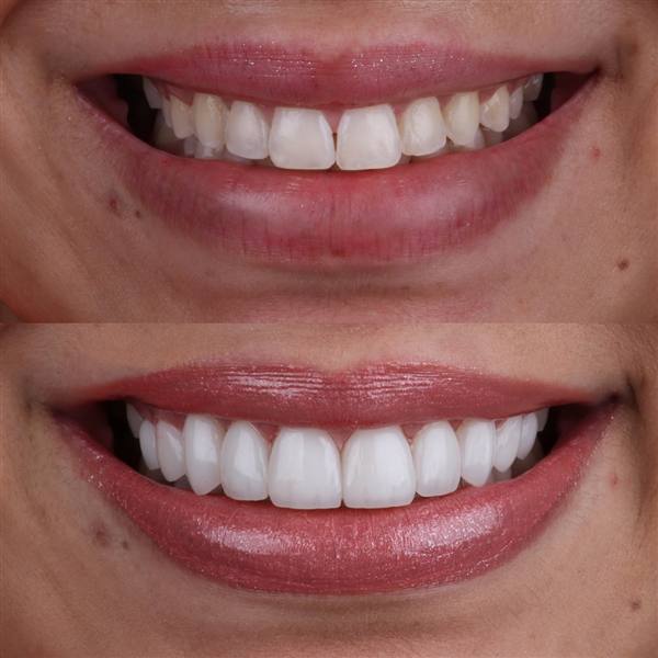 Antes e depois com lentes de modelagem natural