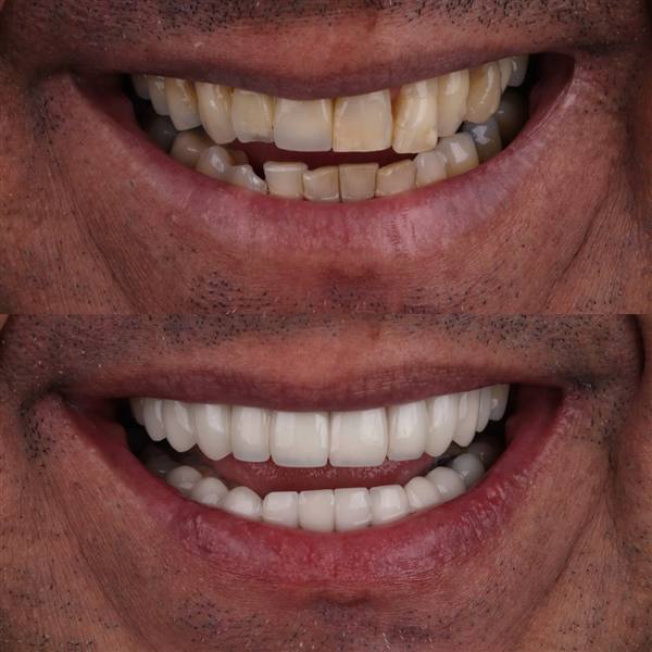Antes e depois com lentes de modelagem natural