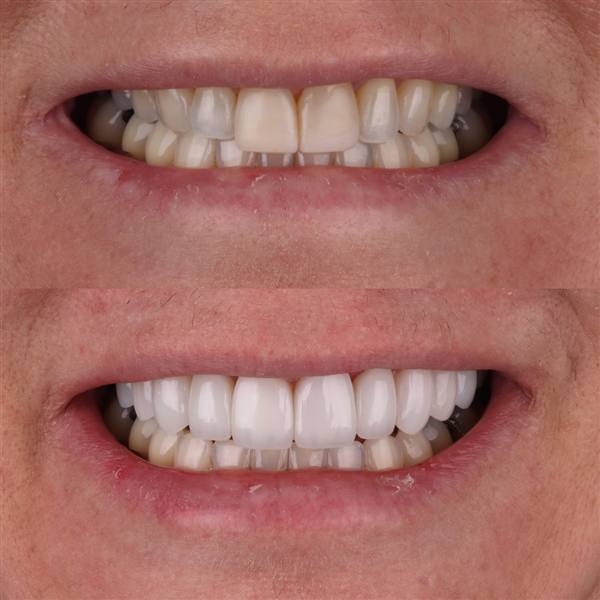 Antes e depois com lentes de modelagem natural