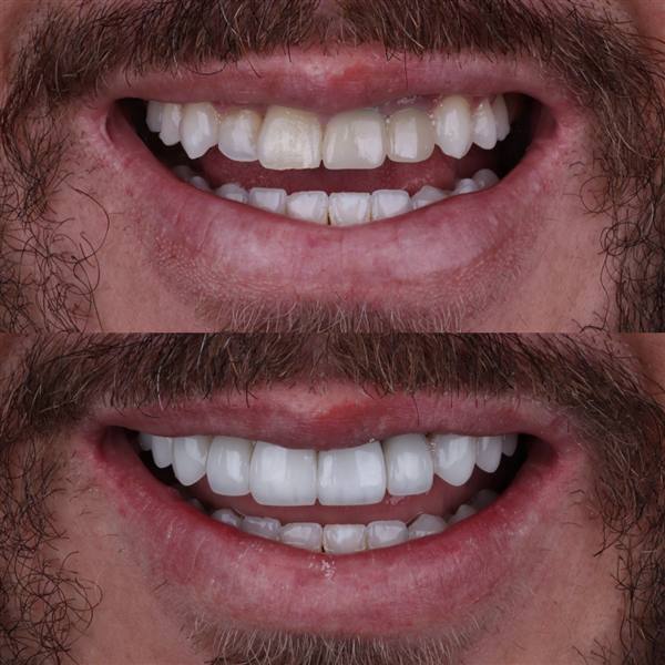 Antes e depois com lentes de modelagem natural