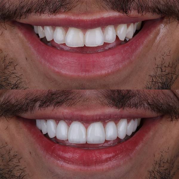 Antes e depois com lentes de modelagem natural