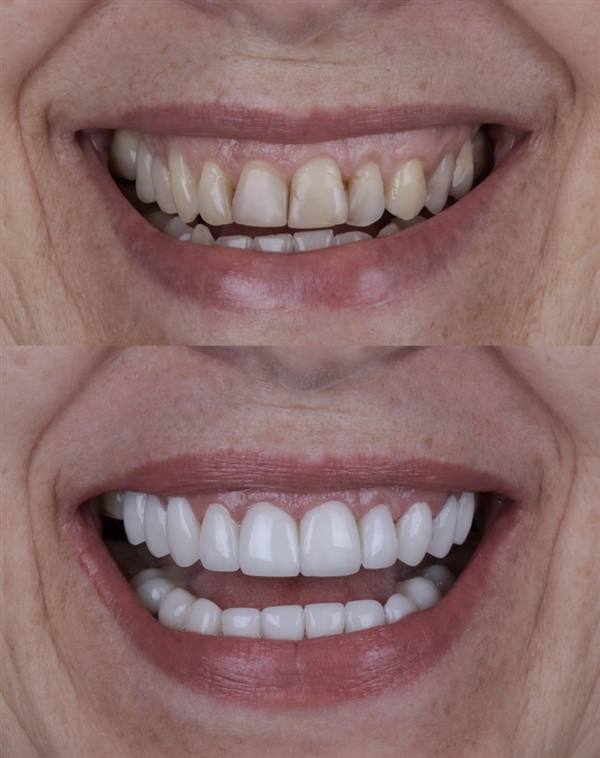 Antes e depois com lentes de modelagem natural