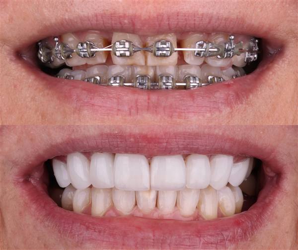 Antes e depois com lentes de modelagem natural