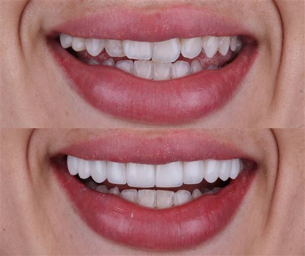 Antes e depois com lentes de modelagem natural