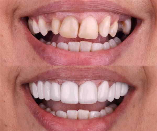Antes e depois com lentes de modelagem natural