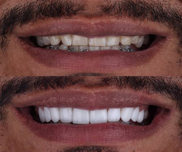 Antes e depois com lentes de modelagem natural