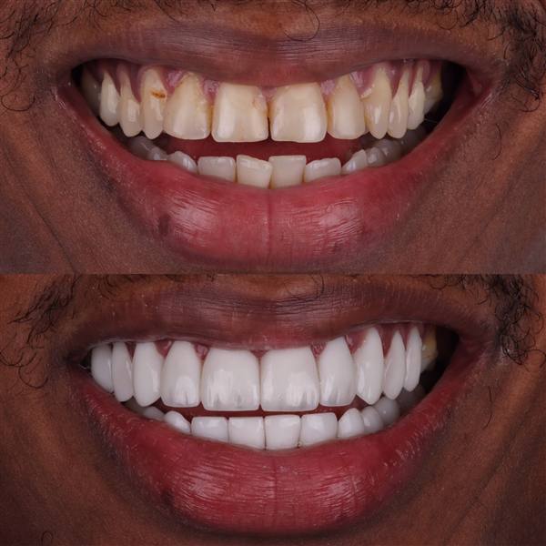 Antes e depois com lentes de modelagem natural