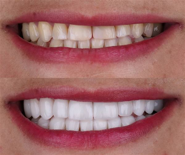 Antes e depois com lentes de modelagem natural