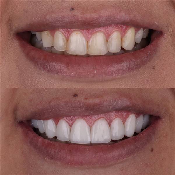 Antes e depois com lentes de modelagem natural