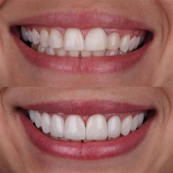 Antes e depois com lentes de modelagem natural