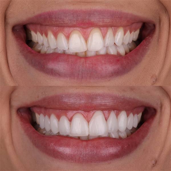 Antes e depois com lentes de modelagem natural