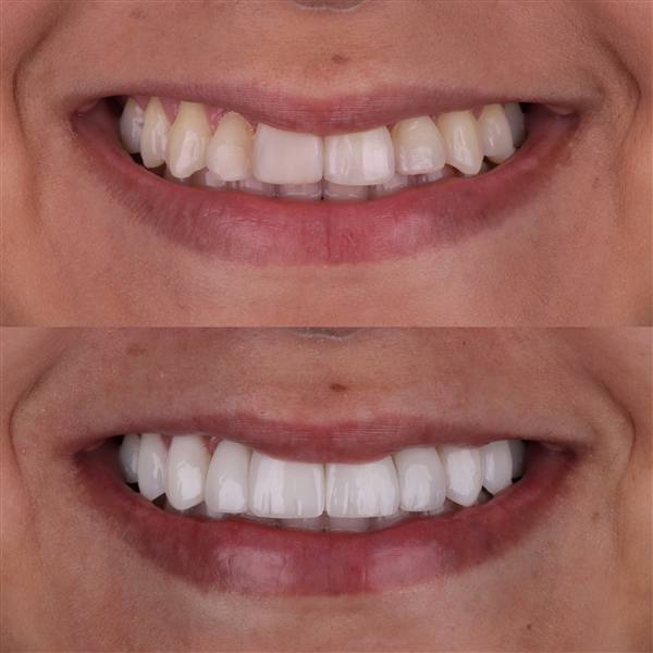 Antes e depois com lentes de modelagem natural