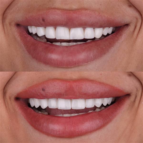 Antes e depois com lentes de modelagem natural