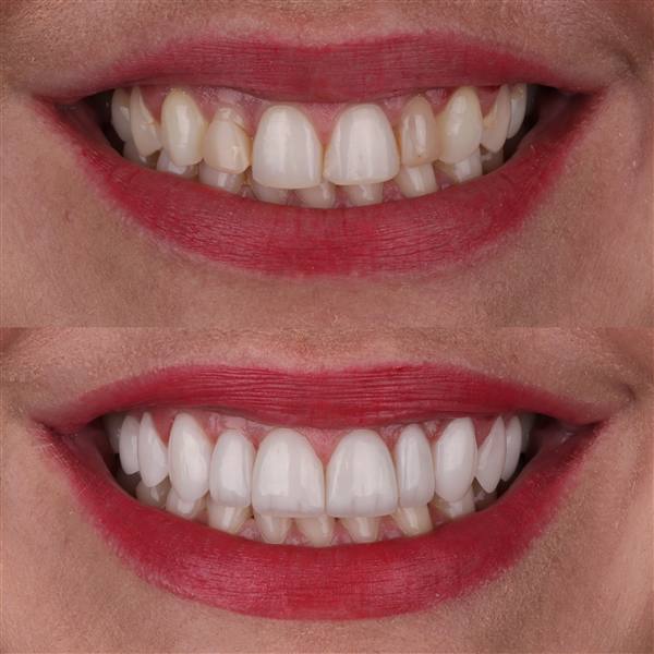Antes e depois com lentes de modelagem natural