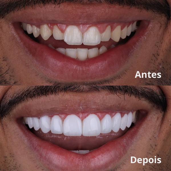 Antes e depois com lentes de modelagem natural
