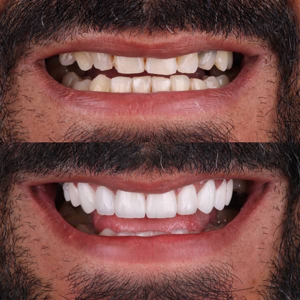 Antes e depois com lentes de modelagem natural