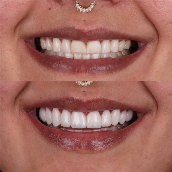 Antes e depois com lentes de modelagem natural