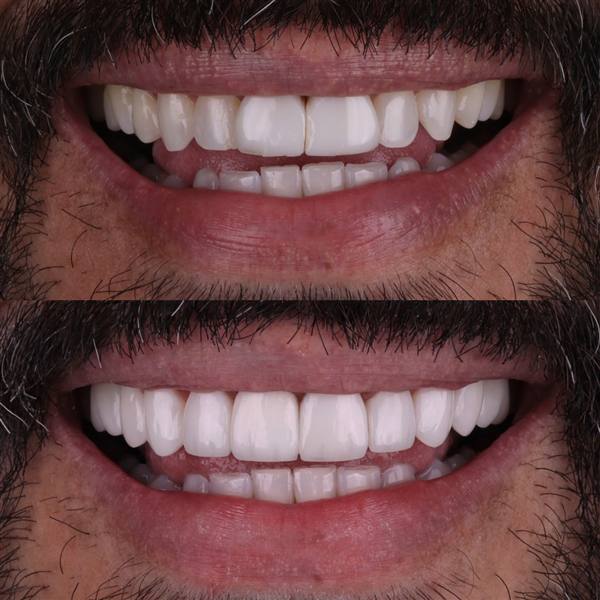 Antes e depois com lentes de modelagem natural