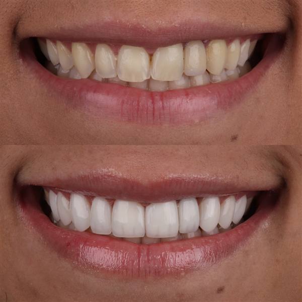 Antes e depois com lentes de modelagem natural
