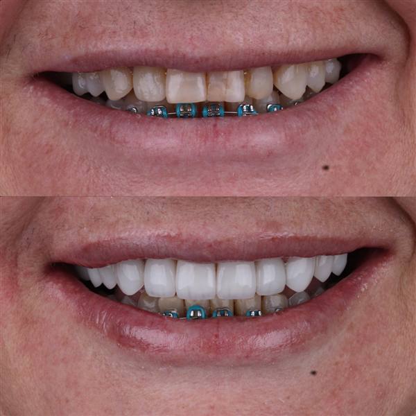 Antes e depois com lentes de modelagem natural